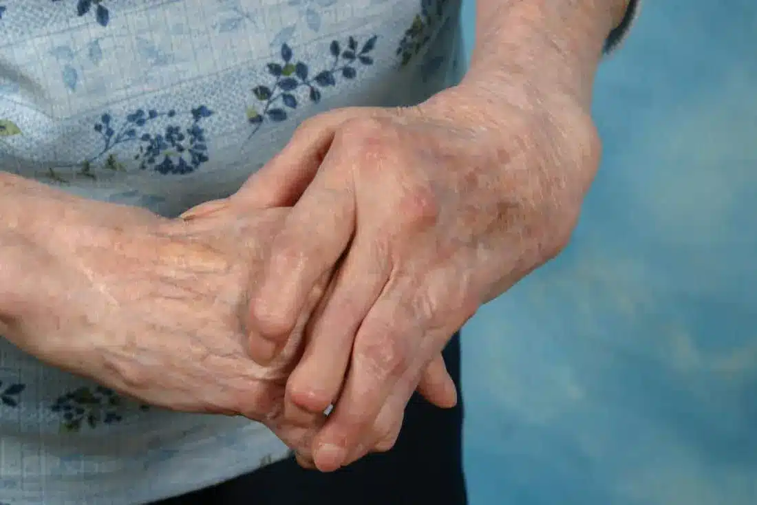 Top 5 Ways to Relieve Arthritis Pain